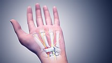 Carpal tunnel syndrome - Wikipedia