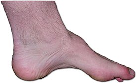 Charcot-marie-tooth foot.jpg