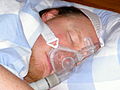 nichtinvasive Maskenbeatmung beim Schlaf-Apnoe-Syndrom