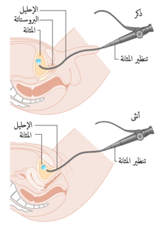 Diagram showing a cystoscopy for a man and a woman CRUK 064-ar.png