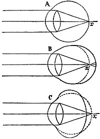 EB1911 Vision - Forms of eye - normal, short and far-sighted.jpg