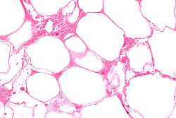 Micrograph of fat necrosis. H&E stain.
