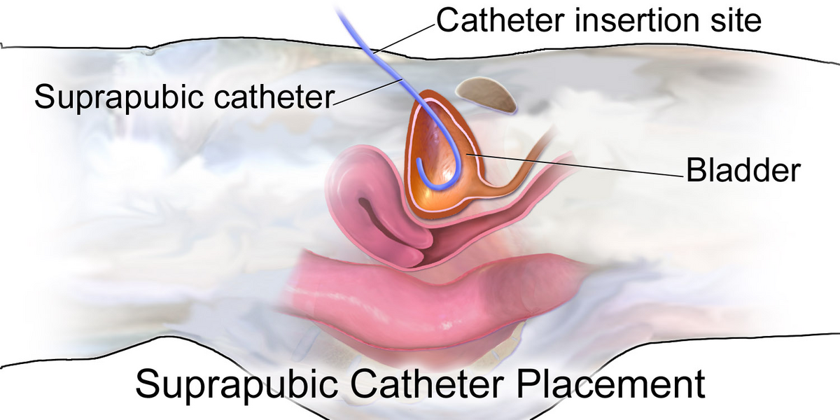 suprapubic catheter