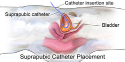 Correct placement of a suprapubic catheter on a female.