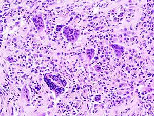 Histopathology of localized TGCT arising in hand finger. H&E stain.