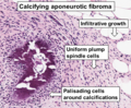 Thumbnail for Aponeurotic fibroma