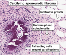 Histopathology of calcifying aponeurotic fibroma.png