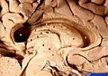 สมองมนุษย์ตัดซีกซ้ายออก ระนาบแบ่งครึ่งซ้ายขวา (midsagittal)