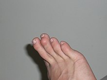 Human foot with mallet toe.jpg