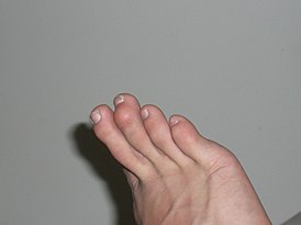 Human foot with mallet toe.jpg