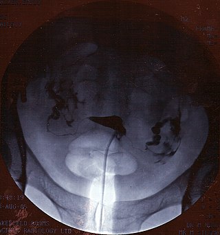 <span class="mw-page-title-main">Hysterosalpingography</span> Radiological procedure