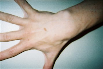 Hand of 37-year-old patient showing interdigital webbing