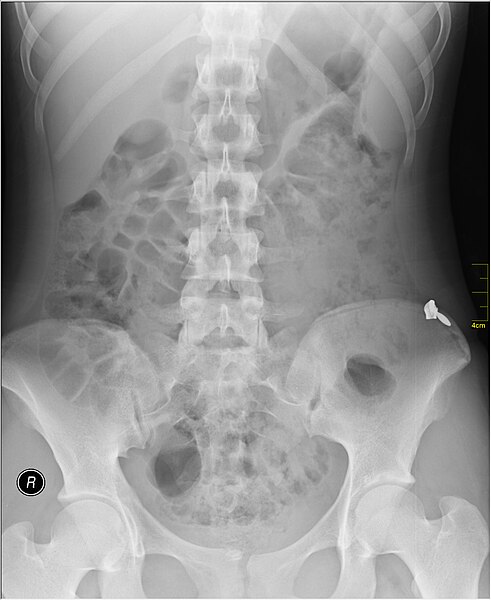 File:Medical X-Ray imaging WEN07 nevit.jpg