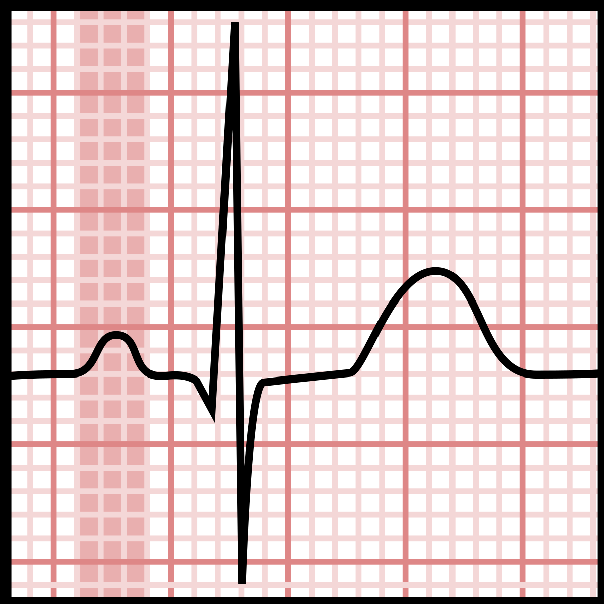 P Wave Electrocardiography Wikipedia