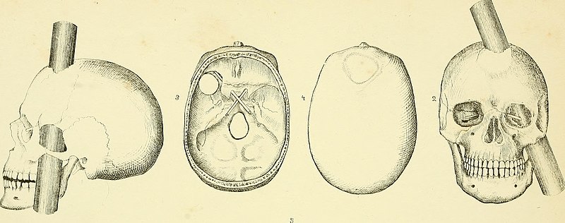 File:Operative surgery illustrated - containing more than nineteen hundred engravings - including two hundred original, and fifty colored drawings- with explanatory text (1852) (14765427832).jpg