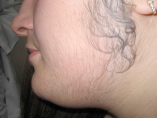 <span class="mw-page-title-main">Hirsutism</span> Hair growth on a woman, generally causing a full beard to grow