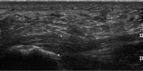 Thickened plantar fascia in ultrasound