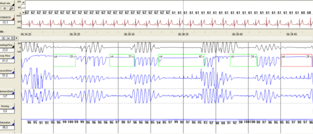 Polysomnography - Wikipedia