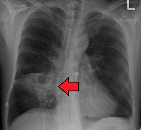 PulmonaryabsCXR.png