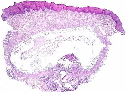 Ranula, micrograph. H&E stain. Ranula, low mag.jpg