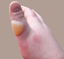 Scalding injury to right hand Scaldburn.jpg