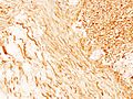 Подкожная шваннома (4) S-100 Immunostain.jpg