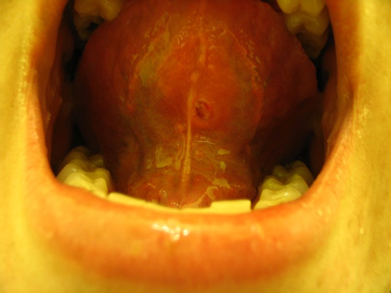 File:Tongue piercing scar bottom.jpg