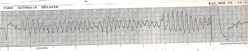 File:Torsades converted by AICD ECG strip Lead II.JPG