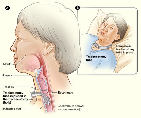 Tracheostomie