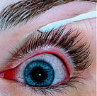 An eye with viral conjunctivitis.jpg