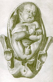 Breech birth