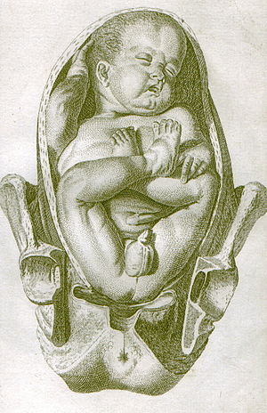 Breech Birth Wikipedia