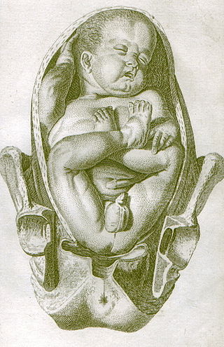 <span class="mw-page-title-main">Breech birth</span> Birth of a baby bottom first