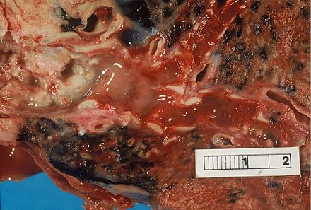 Photograph of a squamous-cell carcinoma obstructing the bronchus.