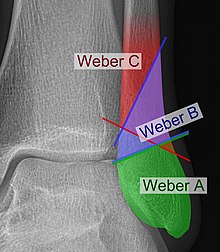 Danis Weber classification Wikipedia