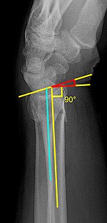 Classification of distal radius fractures