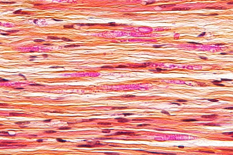 File:Endoneurial fibrosis - very high mag - cropped.jpg