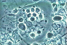 Entamoeba gingivalis from aggressive periodontal disease patient biofilm using phase contrast microscope 1000x. It is recognizable through its dense core in the middle, formed by a central point encircled by a circular halo and surrounded by bigger phagosomes inside a greyish cytoplasm. Entamoeba gingivalis.jpg