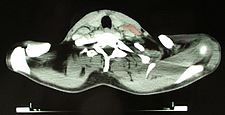 CT obraz pacientky trpící Hodkinovým lymfomem