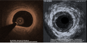 This is a representative image of two types of intracoronary imaging, OCT (left) and IVUS (right). Ivus&oct.png