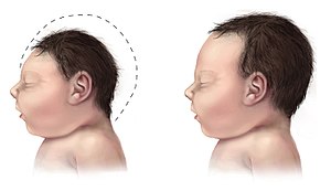 Дитина з мікроцефалією (зліва) порівняно з дитиною з типовим розміром голови