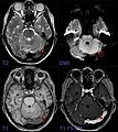 Pacchioni-Granulation im Sinus transversus links 74W - MR axial - 001 - Annotation.jpg