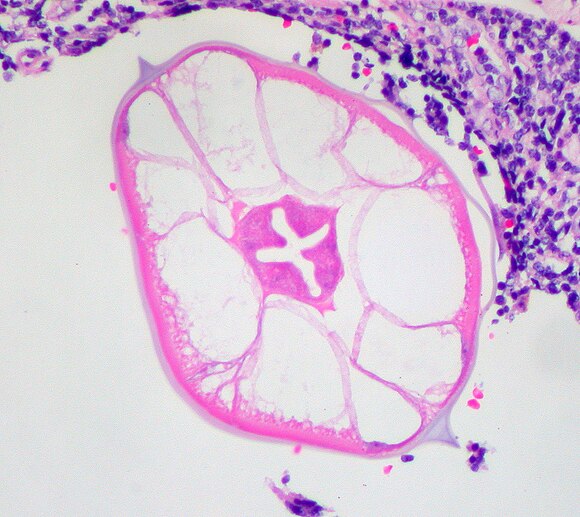 High magnification micrograph of a pinworm in cross section in the appendix. H&E stain.