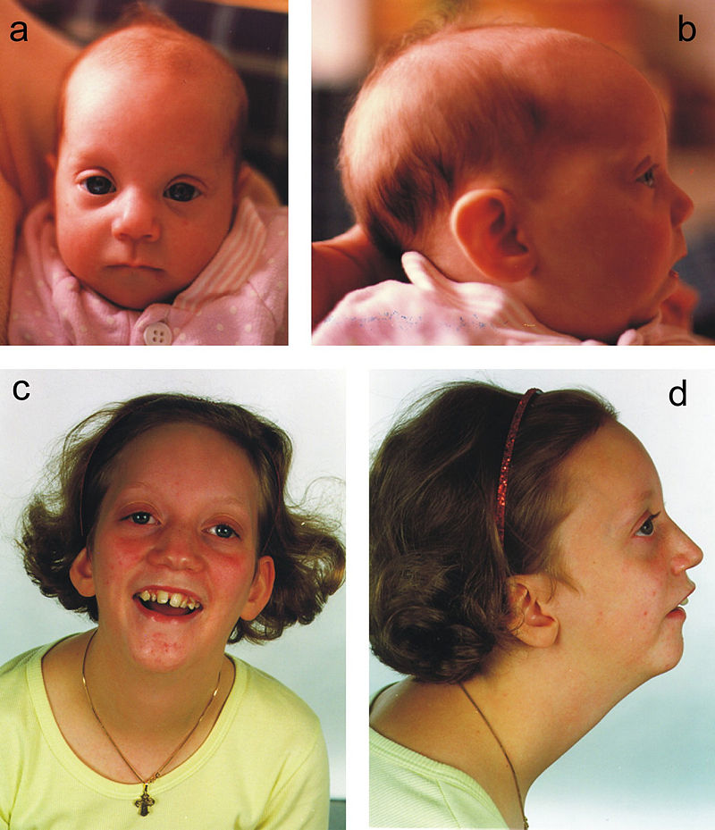 Facial dysmorphism, skeletal anomalies, congenital glucoma