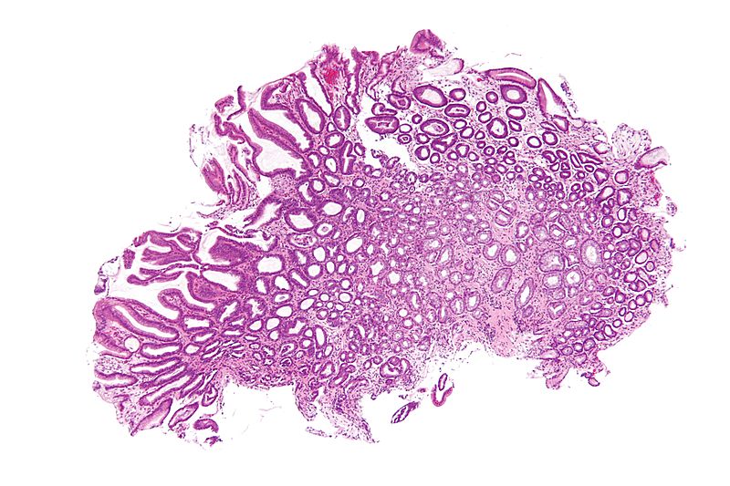 File:Reactive gastropathy - low mag.jpg