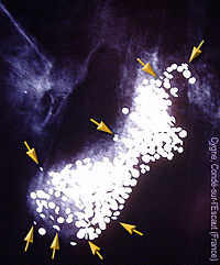 X-ray picture with numerous small pellets highlighted in white