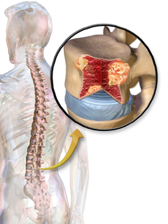 Das Multiple Myelom (MM), häu