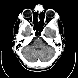 CT scan - Wikipedia