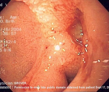 Perforated ulcer