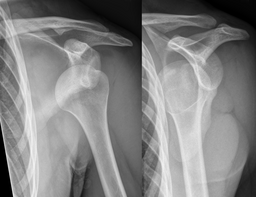 Dislocated shoulder X-ray 10